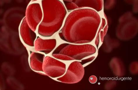 HEMORROIDA TROMBOSADA CAUSAS E TRATAMENTO Hemorroidurgente