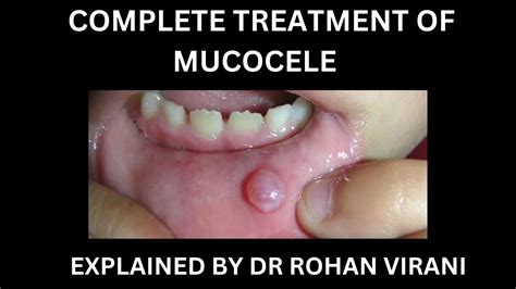 Complete Treatment For Mucocele Explained By Dr Rohan Virani Youtube