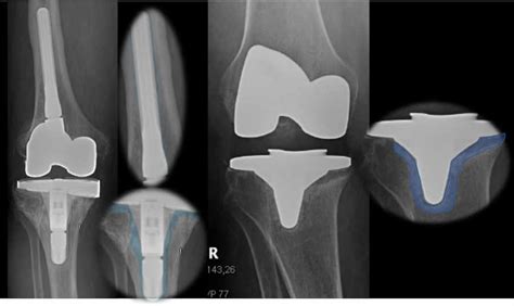 Aflojamiento de Prótesis de Rodilla Dr Pablo Sanz