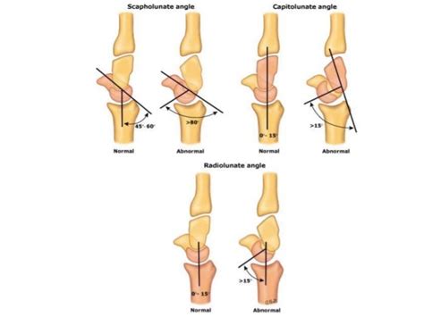 Carpal Instability