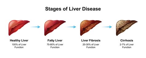 Diseased Liver