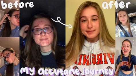 My Accutane Journey How I Cleared My Skin From Severe Acne And Gained