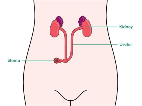 Urostomy – Ileal Conduit – The Australian Council of Stoma Associations Inc