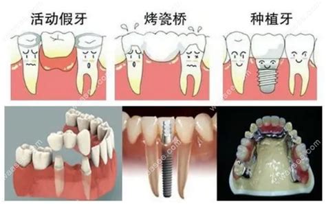 福州镶牙哪家医院好装假牙烤全瓷牙便宜又好的牙科有10家 口腔资讯 牙齿矫正网