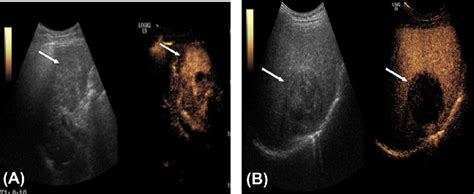 A Prior To Hepatic Radiofrequency Ablation RFA The Image Of The