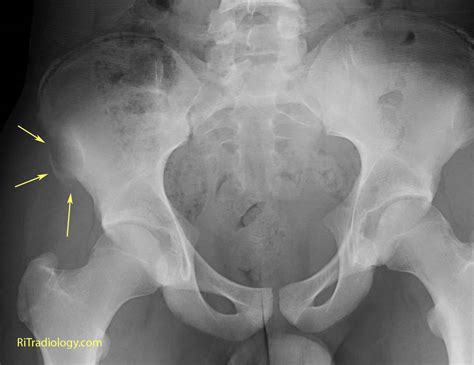 Lateral Compression Pelvic Fracture A pelvic radiograph