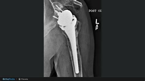 Complex and Revision Shoulder Arthroplasty: Humeral Considerations in ...