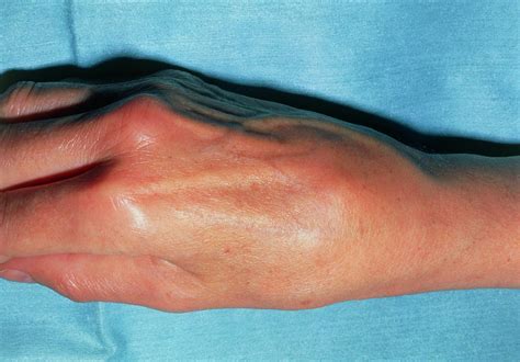 Swollen Right Hand Due To Osteoarthritis In Wrist Photograph by Science ...