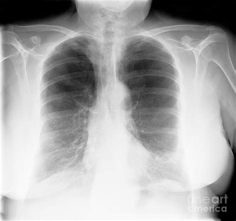 Lung Disease, X-ray Photograph by Science Photo Library | Pixels