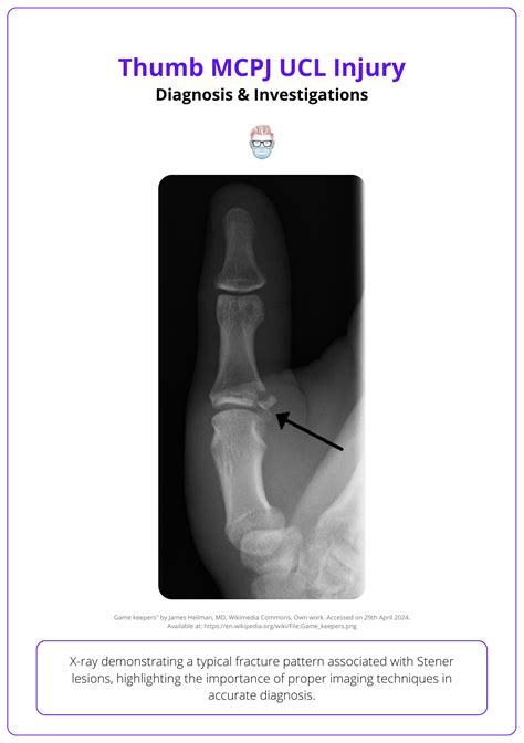 Radial Collateral Ligament Thumb Pain