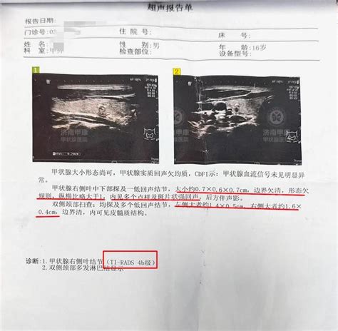 16岁少年患4b类甲状腺结节怎么治？ 知乎