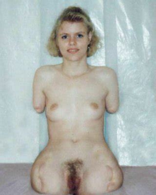 Amputee Porn Pictures Xxx Photos Sex Images Pictoa