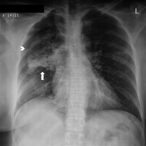 Iatrogenic Pneumothorax Following Vigorous Suctioning Of Mucus Plug