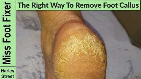 How To Cut Out A Callus On Foot At Michael Curnutt Blog