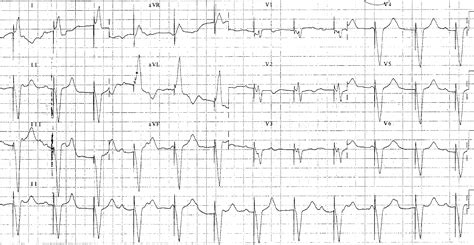 Early Complications After Pacemaker Implantations Intechopen