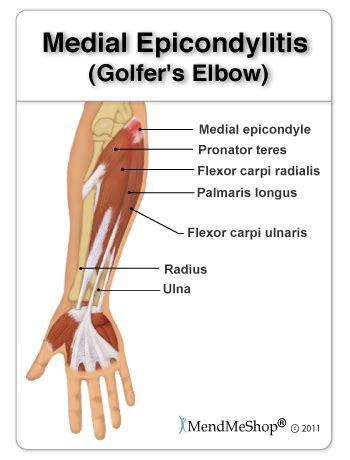 Information About Medial Epicondylitis, aka. Golfers Elbow