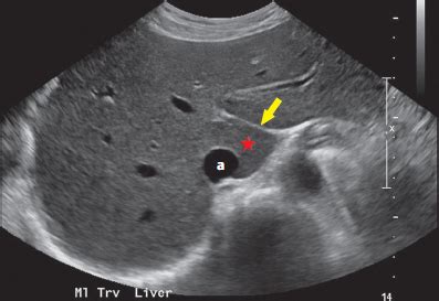 Chapter 5 Hepatobiliary | Radiology Key