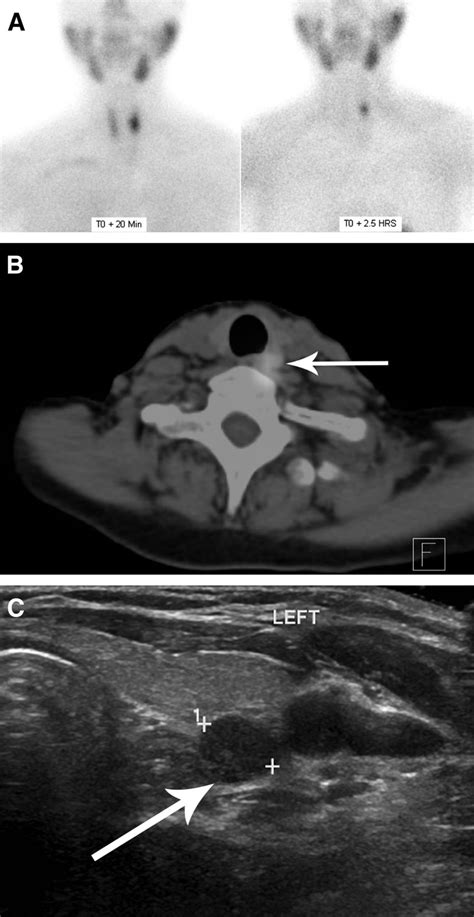 Parathyroid Nodule Ultrasound