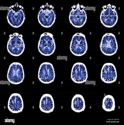 Coloured Computed Tomography Ct Scans Showing Electrodes Implanted In