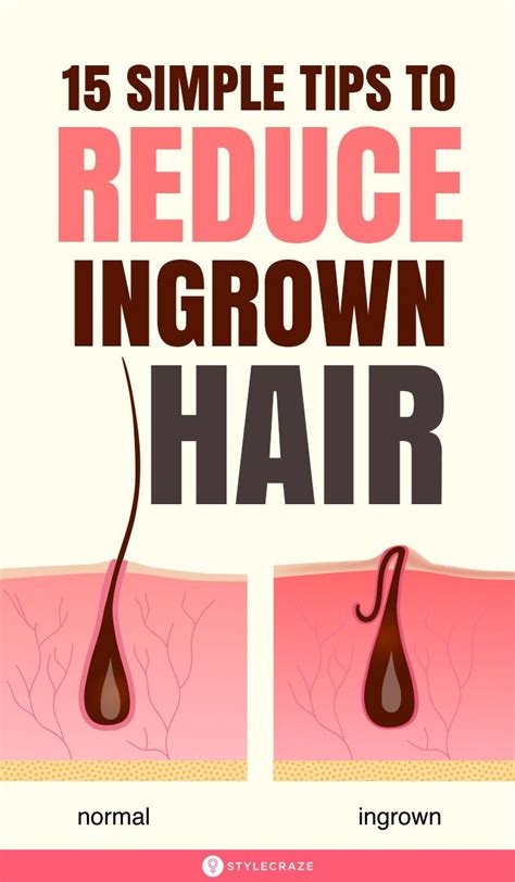 How To Remove Ingrown Hair Pimple - HOWOTREMO