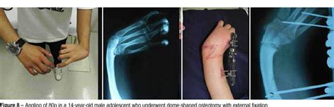 Figure 1 From Congenital Deformities Of The Upper Limbs Semantic Scholar