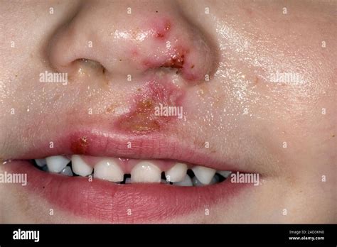 Impetigo On The Face Close Up Of A Rash On The Face Of A 3 Year Old