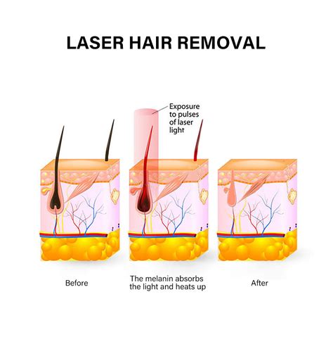 808 diode laser hair removal advantages