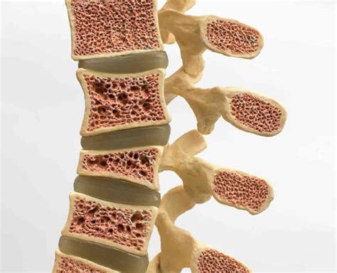 Guía Completa sobre la Fractura Vertebral Osteoporótica