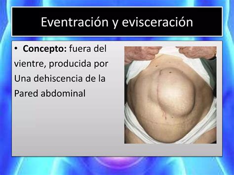 Hernias De La Pared Abdominal Eventracion Y Eviceracion Generalidades Tipos Diagnostico Y