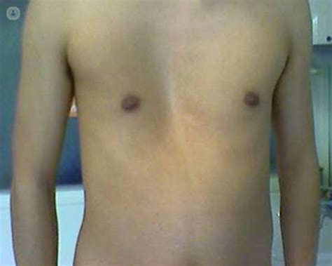 Pectus : Pectus Carinatum Case Histories : This causes a depression of ...