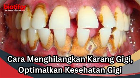 Cara Menghilangkan Karang Gigi Optimalkan Kesehatan Gigi Biotifor