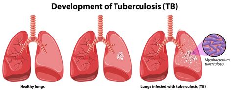 Chart Showing Development Of Tuberculosis Vector Art At Vecteezy