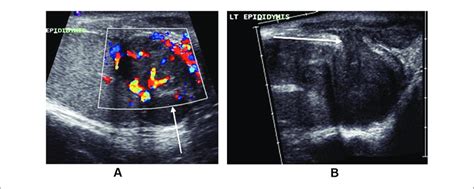 A Left Testis And Epididymis Arrow Pointing To The Thickened And Download Scientific Diagram