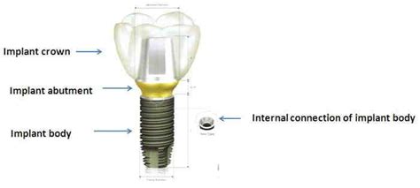 What Is A Dental Implant Abutment Dental News Network