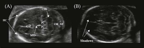 Spatial Compounding Of D Fetal Brain Ultrasound Using Probabilistic