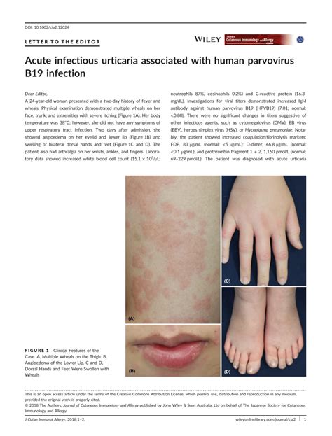 Pdf Acute Infectious Urticaria Associated With Human Parvovirus B