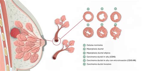 Fisiopatologia Del Cancer De Mama