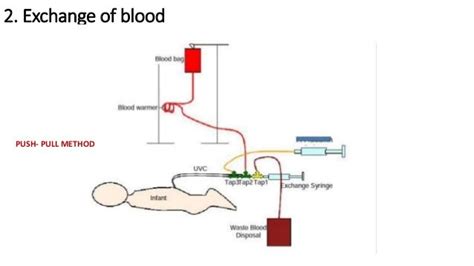 Exchange transfusion