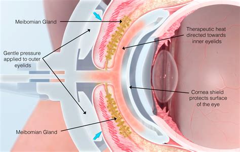 Lipiflow® Dry Eye Treatment Omaha Primary Eye Care