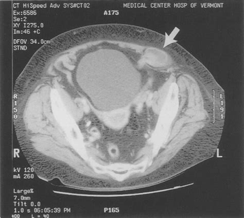 Spigelian Hernia With Incarcerated Bowel Download Scientific Diagram