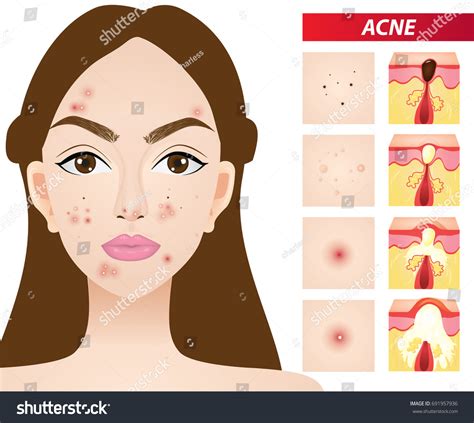 Types Acne Skin Problems Vector Illustration 库存矢量图（免版税）691957936