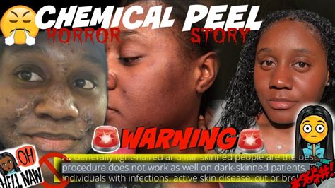 Chemical Peel Experience Black Girl Friendly Youtube