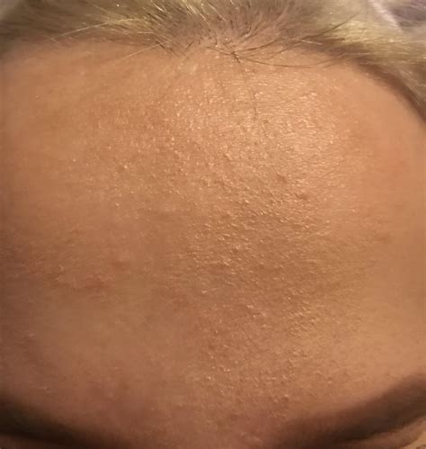 Does Anyone Know How I Can Clear Up My Dry Textured Forehead I Feel Like Ive Tried Everything