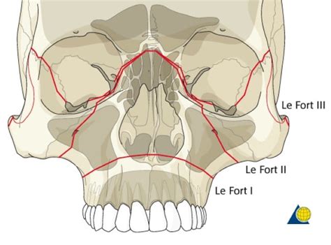 Maxillofacial Trauma: Maxillary Fractures