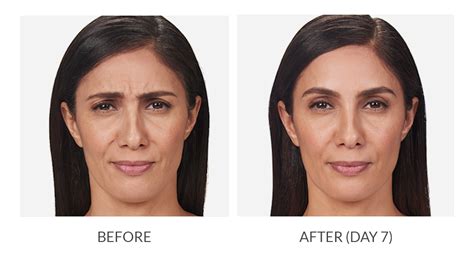 Botox Cosmetic Before After Photos Glendale Dermatology