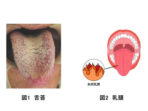 舌苔（ぜったい） みんなの医療ガイド 兵庫医科大学病院