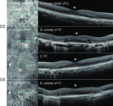 Spectral Domain Optical Coherence Tomographic Sd Oct Images Of The