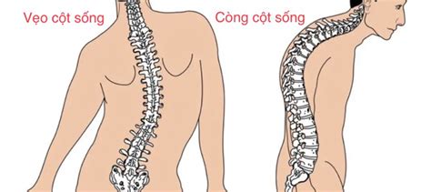 Tìm Hiểu Về Hình ảnh Vẹo Cột Sống Và Phương Pháp điều Trị