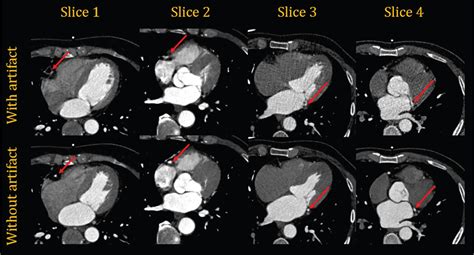 Correcting Motion Artifacts In Coronary Computed Tomography Angiography