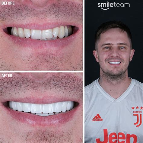 Before And After Dental Treatments Photos Smile Team Turkey